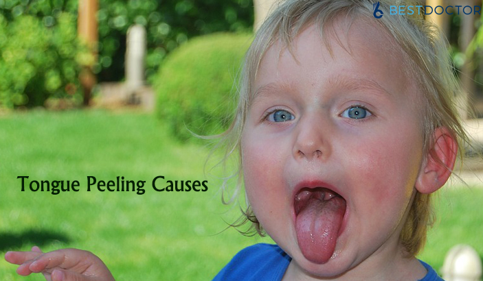 Tongue Peeling Causes,how to stop tongue peeling - bestdoctor.com