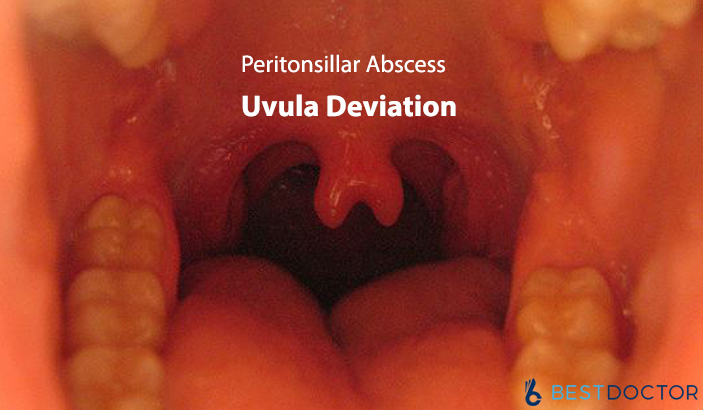 uvula deviation