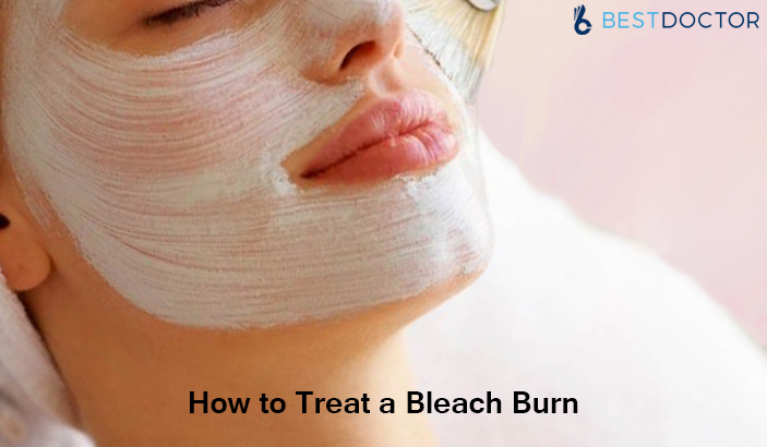 how to treat a bleach burn