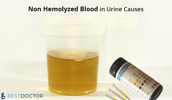 non hemolyzed blood in urine causes during pregnancy