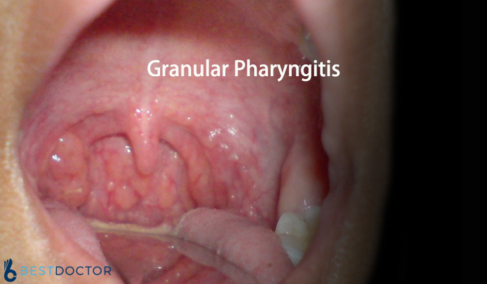 Granular Pharyngitis