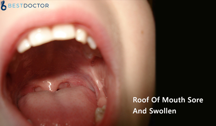 Roof Of Mouth Sore And Swollen