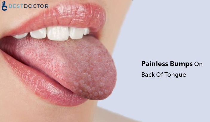 Painless Bumps On Back Of Tongue