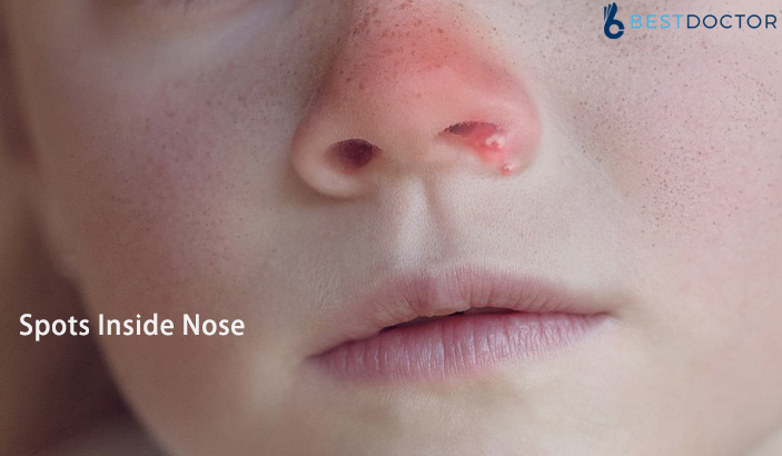Spots Inside Nose