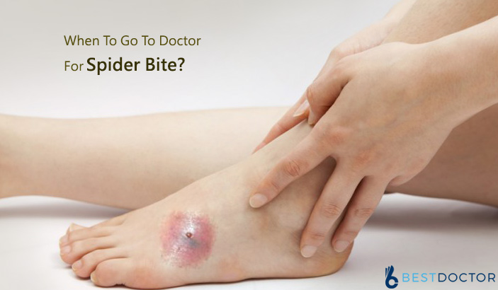 When To Go To Doctor For Spider Bite?
