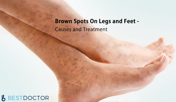 Brown Spots On Legs and Feet - Causes and Treatment