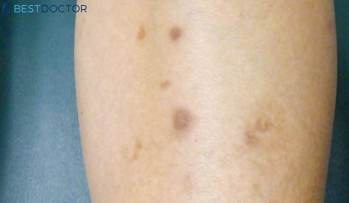 ar kran problem Brown Spots On Legs and Feet - Causes, Treatment, Pictures By Dr. Ahmed