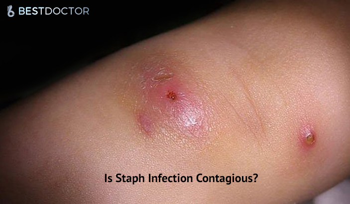 Is Staph Infection Contagious?