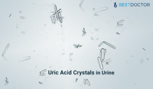 Uric Acid Crystals In Urine - Causes, Symptoms, Prevention, Treatment