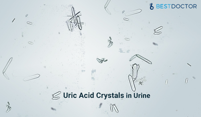 Uric Acid Crystals in Urine