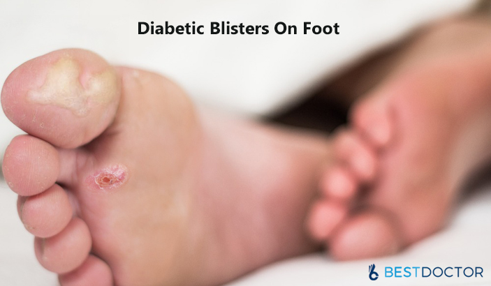 diabetic blisters on legs