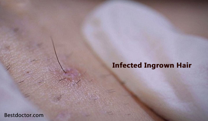How To Treat Infected Ingrown Hair?