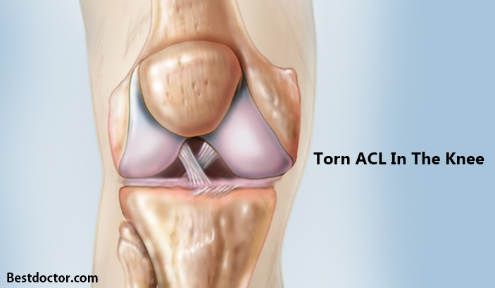 Torn ACL In The Knee