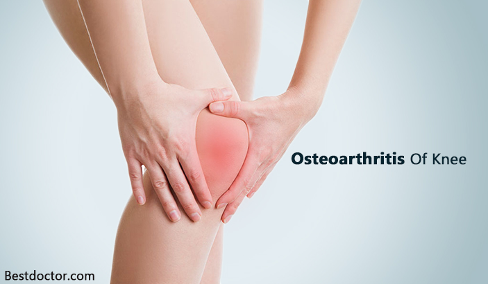 Osteoarthritis Of Knee