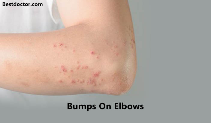 Bumps On Elbows