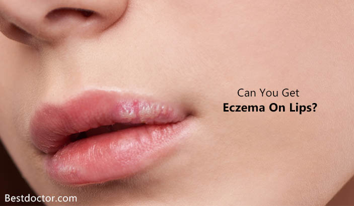 Can You Get Eczema On Lips