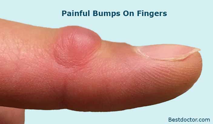 Painful Bumps On Fingers