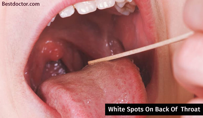 Will patches strep from throat when disappear the white How painful