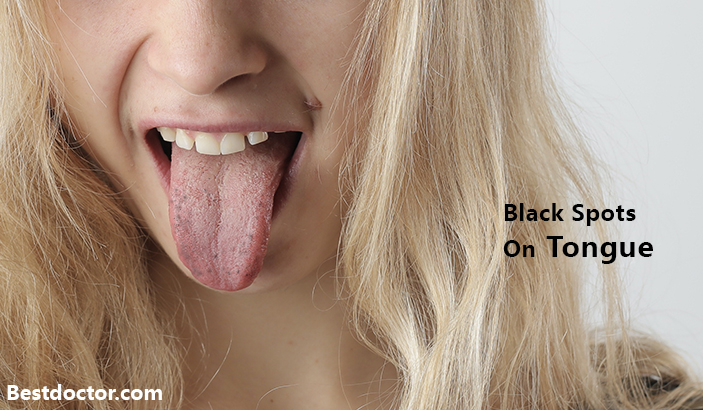Balck Spots On Tongue