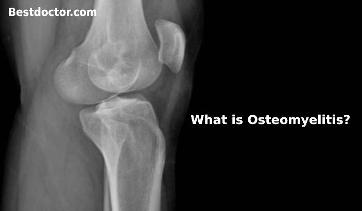 What is Osteomyelitis Bone Infection?