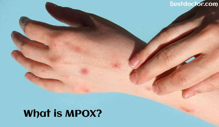 What-is-MPOX