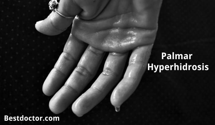 Palmar Hyperhidrosis: Causes, Treatment, Botox, Surgery